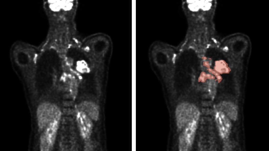 Automated methods enable the analysis of PET/CT scans (left) for precise prediction of tumor location and size (right).